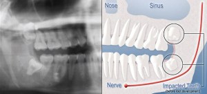 diagram impacted teeth